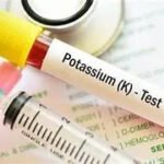 Potassium K+ (Urine) Lab Test